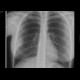 Rib tumour: X-ray - Plain radiograph